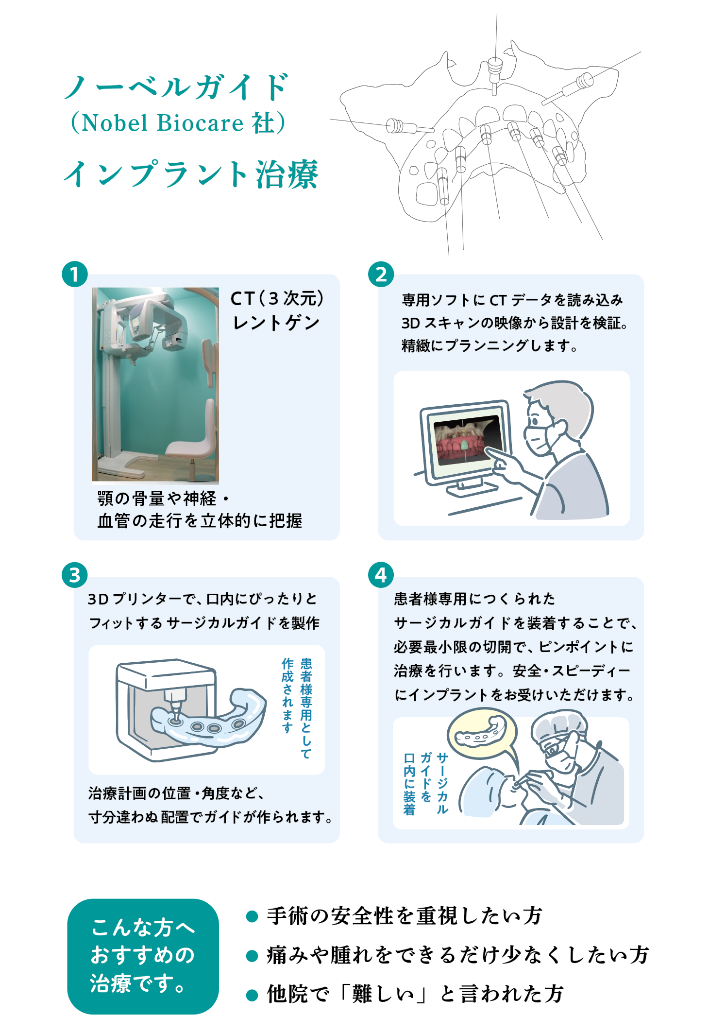 インプラント治療 ノーベルガイド