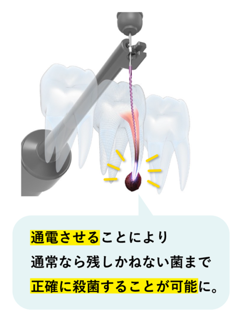 Root-ZX3 | 岡野歯科医院|京都市 左京区 – 北白川 銀閣寺すぐの歯医者